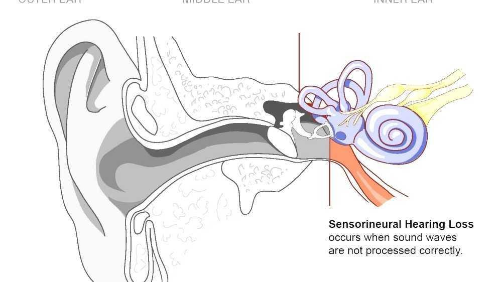 alka yagnik sensorineural hearing loss